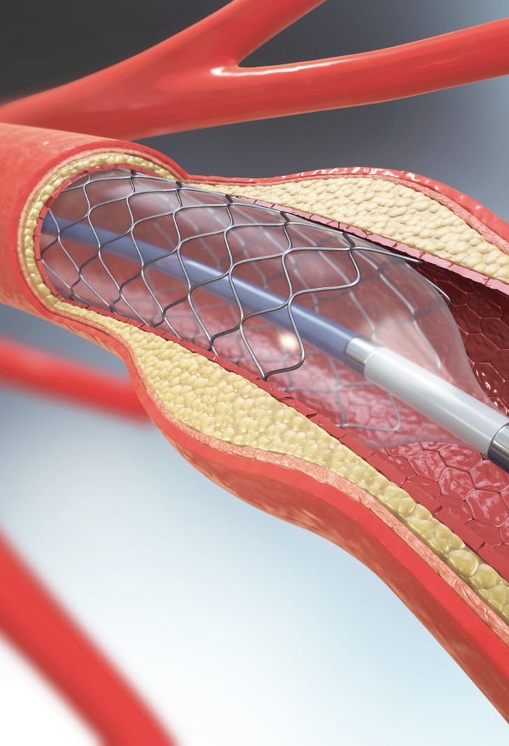 Abstract view of stent