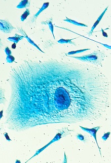 prostate cancer cells