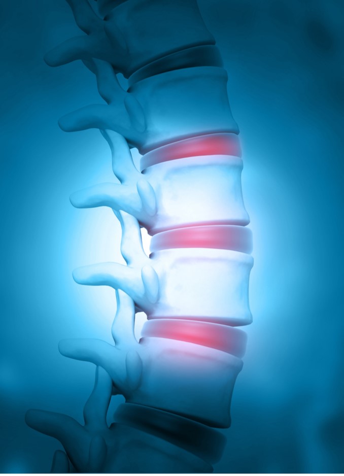 Animated image of the spine showing placement of discs